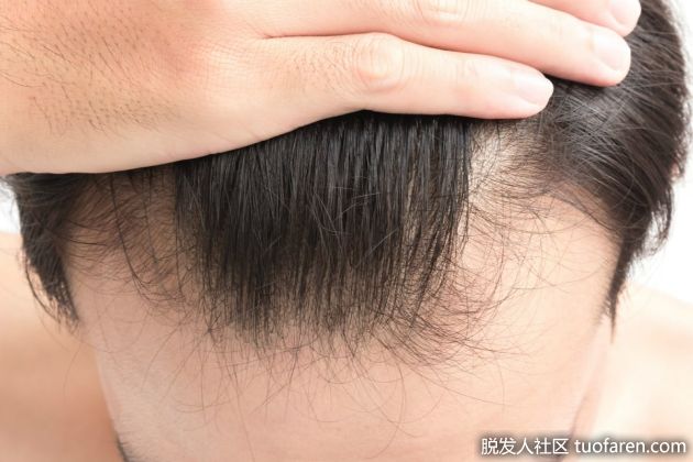 【圖】25歲以下男性脱髮的3個可能原因