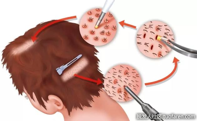 【圖】頭髮移植後要做的13件事