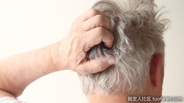 【圖】如何治療頭皮皮疹