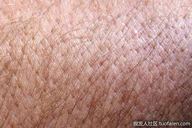 【圖】是什麼導致身體脱髮？