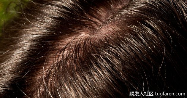 【圖】頭髮油膩稀疏