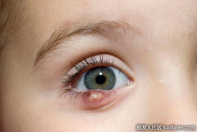 【圖】霰粒腫和睫毛脱落