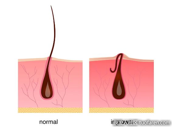【圖】如何防止鬍鬚向內生長