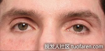 【圖】為什麼有些人沒有睫毛？