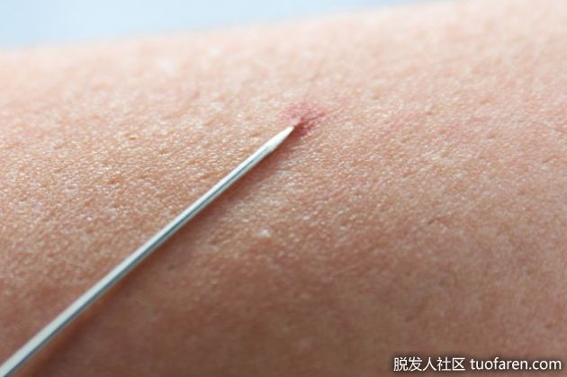 【圖】如何去除手臂內生毛髮