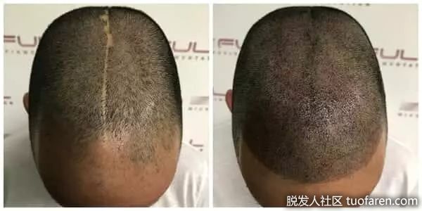 【圖】如何修復頭皮上的疤痕