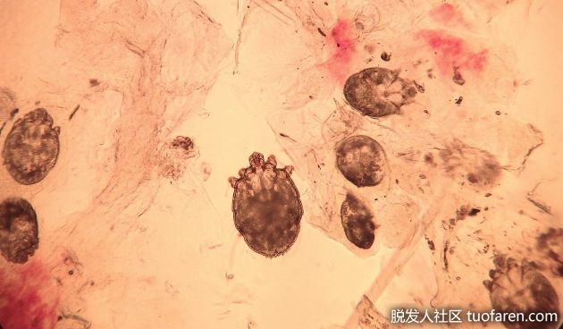 【圖】如何去除頭髮上的疥瘡