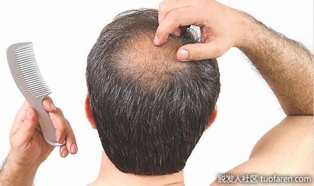 【圖】脱髮：睾丸激素是罪魁禍首嗎？