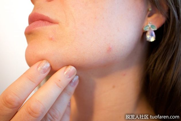 【圖】女性高睾酮的治療方法是什麼？