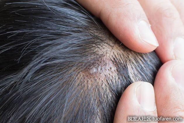 【圖】茶樹油的使用方法（用於頭皮痤瘡）