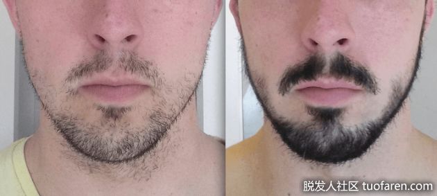 【圖】米諾地爾對鬍子有用嗎？