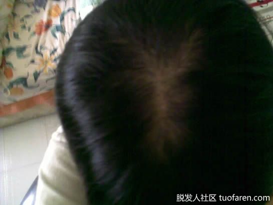 【圖】米諾地爾需要多長時間使頭髮完全再生？