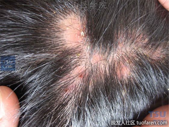 【圖】什麼是毛囊炎性脱髮？