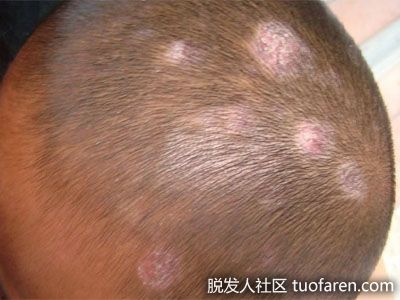 【圖】什麼是頭癬？