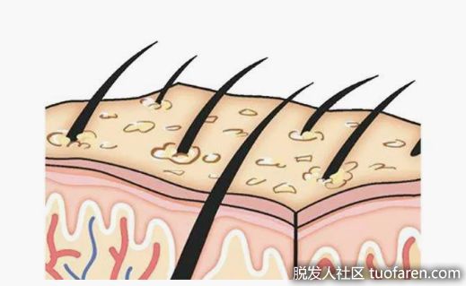 【圖】新生植髮：脱髮部位的細小絨毛怎麼長成頭髮?
