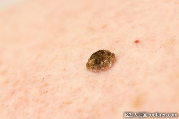 【圖】脂溢性角化症的家庭療法