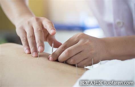 【圖】針灸的好處