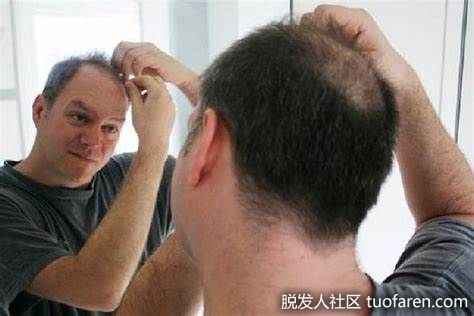 【圖】4種已證實的對抗脱髮和再生頭髮的方法