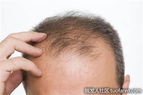 【圖】什麼是脂溢性脱髮