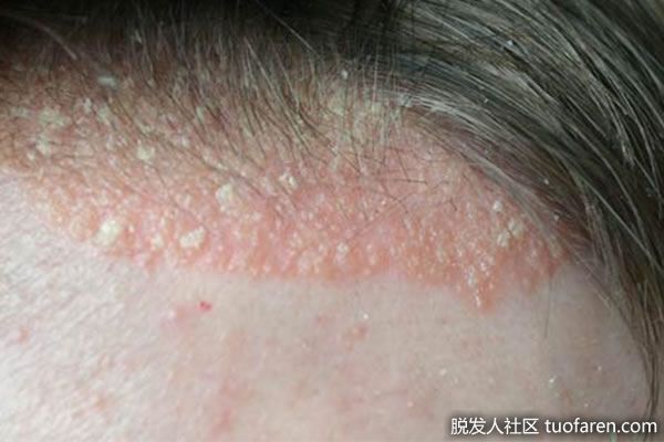 【圖】脂溢性皮炎與脱髮的關係