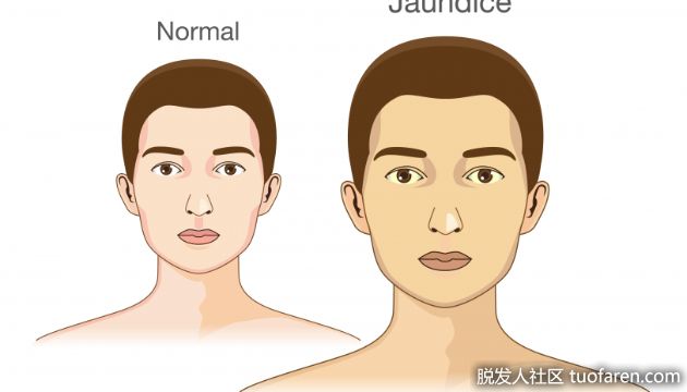 【圖】過量的維生素A會使皮膚變黃嗎