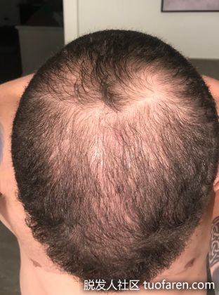 【圖】什麼是瀰漫性脱髮？