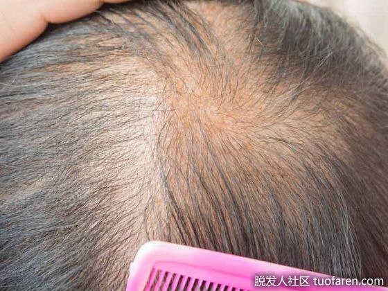 【圖】瀰漫性脱髮的原因是什麼