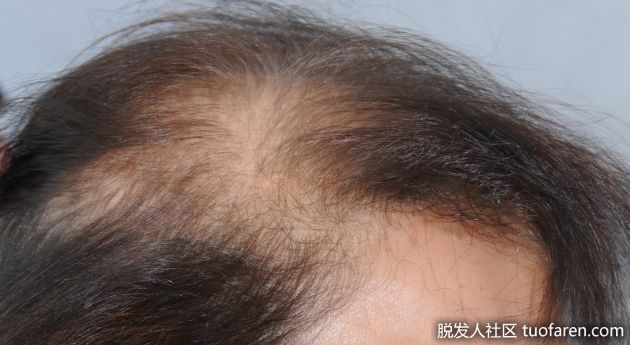 【圖】如何治療瀰漫性脱髮？