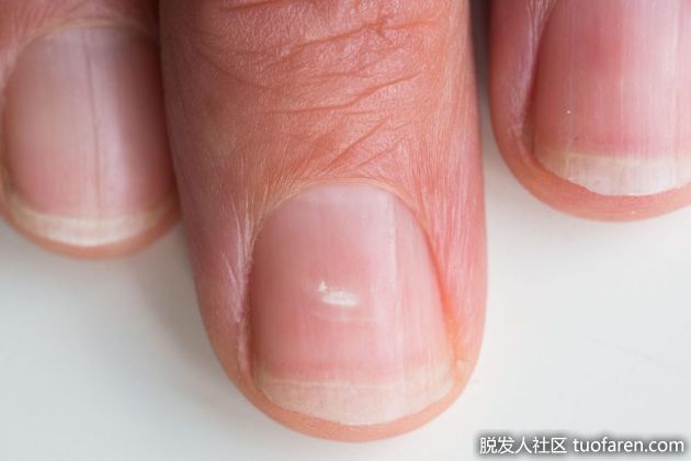 【圖】指甲的生長所需營養
