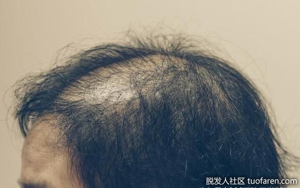 【圖】女性脂溢性脱髮症狀