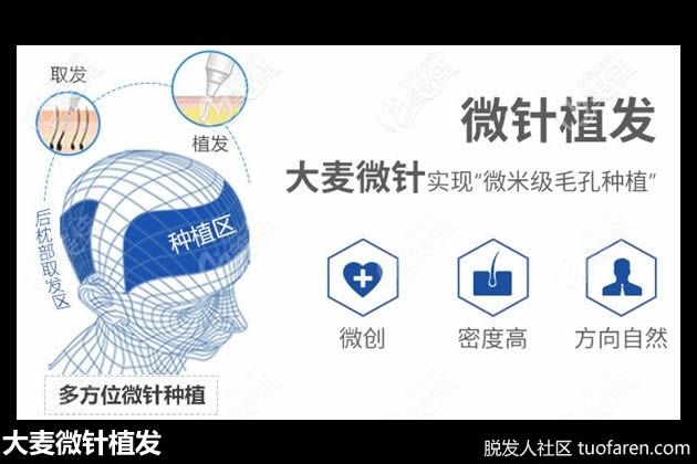 【圖】大麥微針植髮：最近掉頭髮突然增多的原因