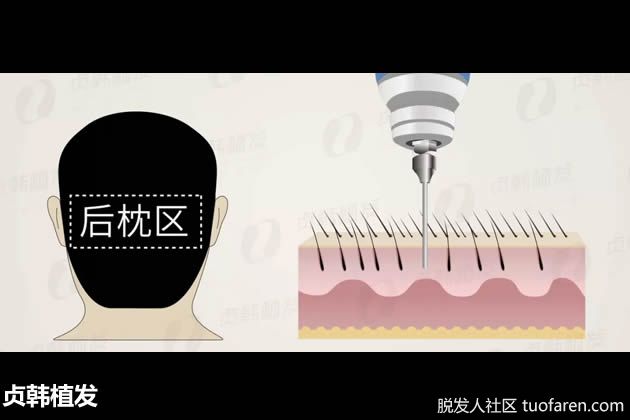 【圖】貞韓植髮：植髮後，額頭出現水腫正常嗎?該怎麼辦？