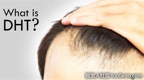 【圖】DHT脱髮的原因和治療方法