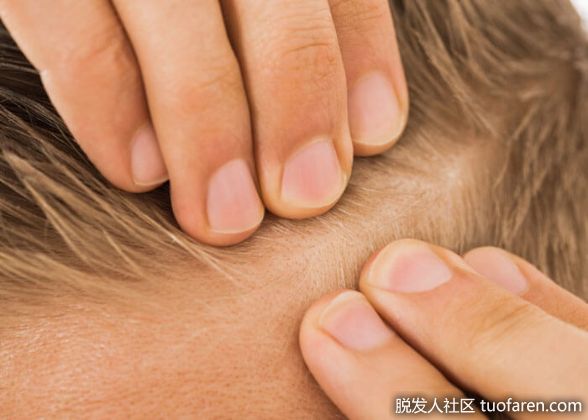 【圖】如何治療局部脱髮