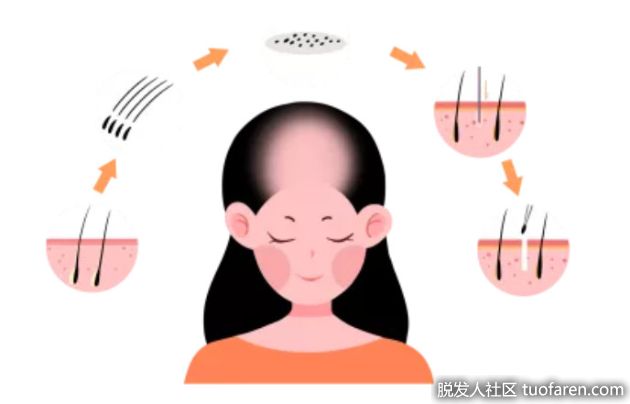 【圖】脱髮和正常掉髮有本質區別