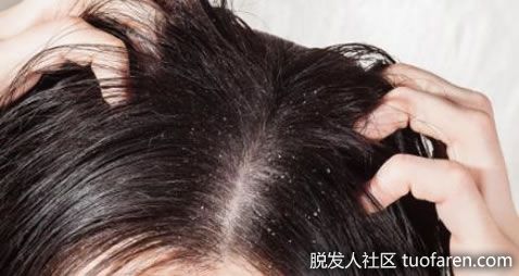 【圖】頭部脂溢性皮炎的症狀和治療方法