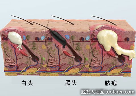 【圖】頭皮上長小疙瘩是怎麼回事圖片