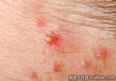 【圖】毛囊炎疙瘩圖怎麼消除