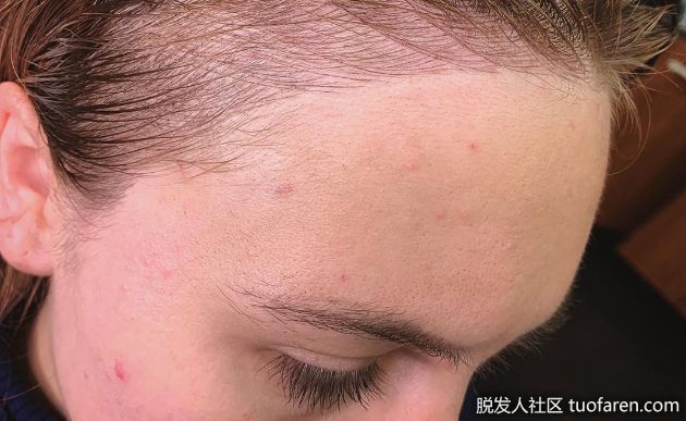 【圖】頭髮扎太緊會導致髮際線後移嗎？