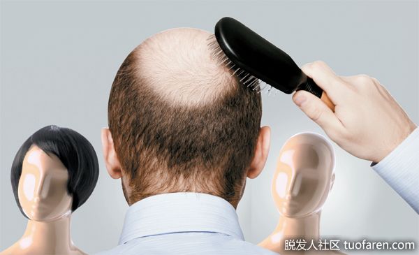 【圖】男性也會出現女性雄性脱髮！雄性脱髮治療診斷大解密