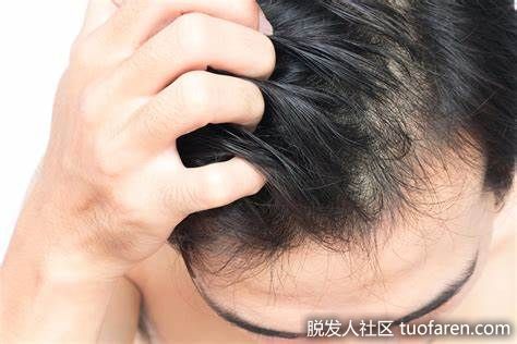 【圖】90%的頭皮問題，都是因為你不夠了解他們