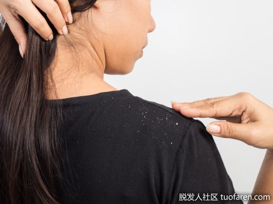 【圖】頭皮屑愈洗愈多?沒想到這樣洗髮全錯了