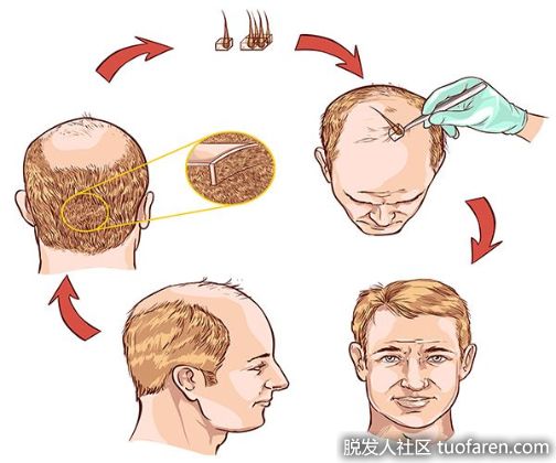 【圖】植髮手術常見Q&A