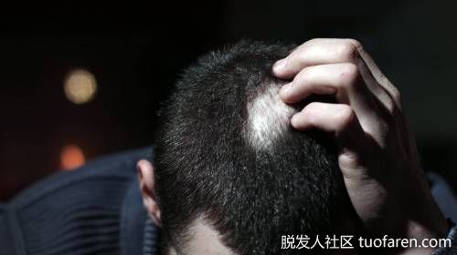 【圖】鬼剃頭超自卑!中醫讓他長回烏黑秀髮