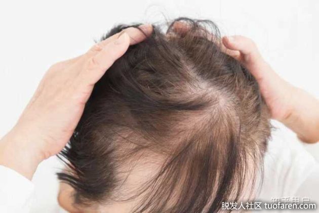 【圖】頭髮變薄要注意!4大重點分析脱髮成因、預防治療方法