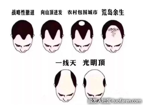 【圖】【脱髮】未老先衰4大脱髮類型