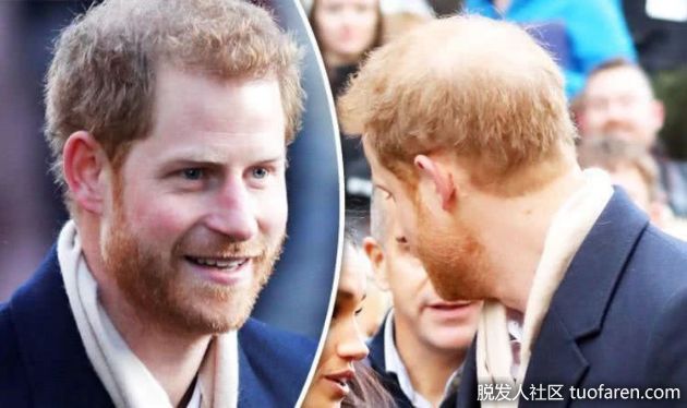 【圖】哈里王子脱髮疑加速 醫生勸儘快治療否則50歲變禿頭