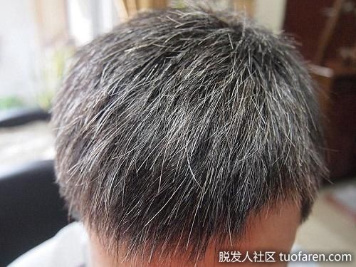 【圖】早生白髮與血腎有關? 3個穴位助白髮變黑頭痛都適用