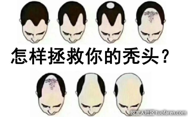 【圖】貧血缺蛋白質11個脱髮成因　6個穴位改善髮際線後移Ｍ字額