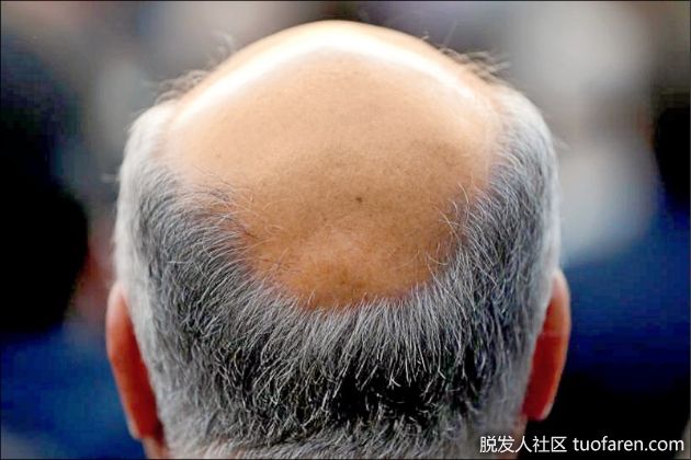 【圖】防脱偏方多 營養均衡才是王道